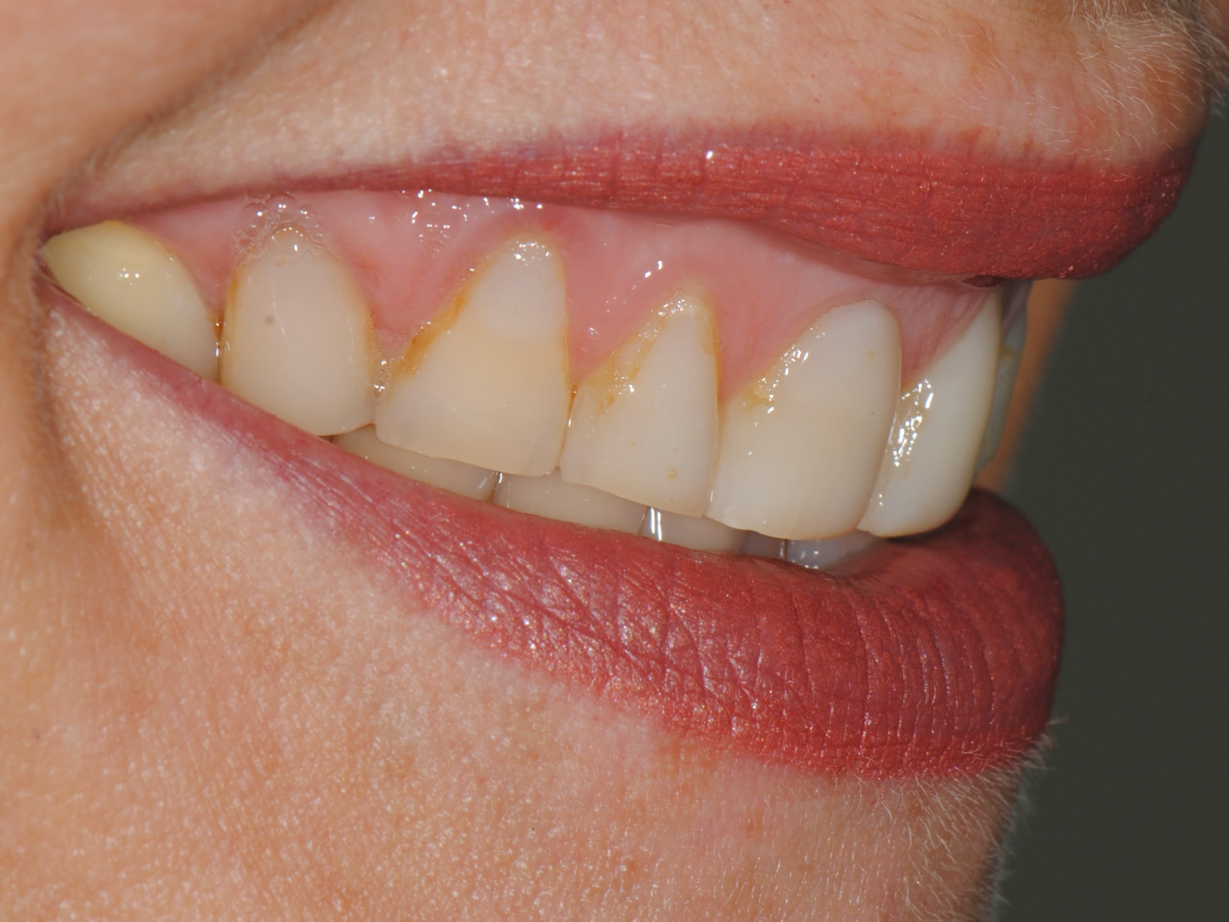 20 porcelain veneers on upper and lower teeth, before treatment, left side view of smile