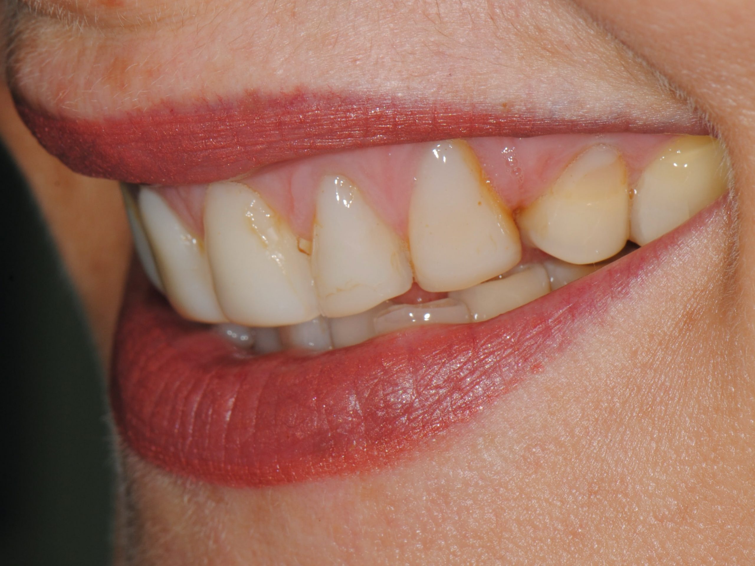 20 porcelain veneers on upper and lower teeth, before treatment, right side view of smile