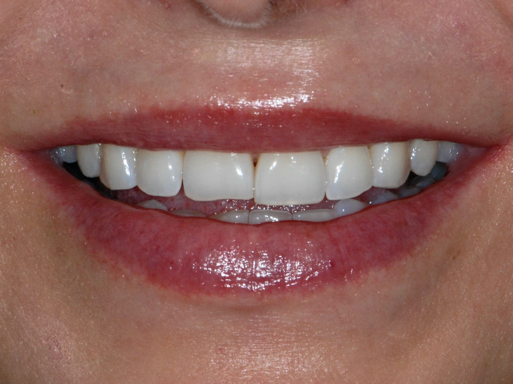 10 porcelain veneers, before treatment, front view of smile