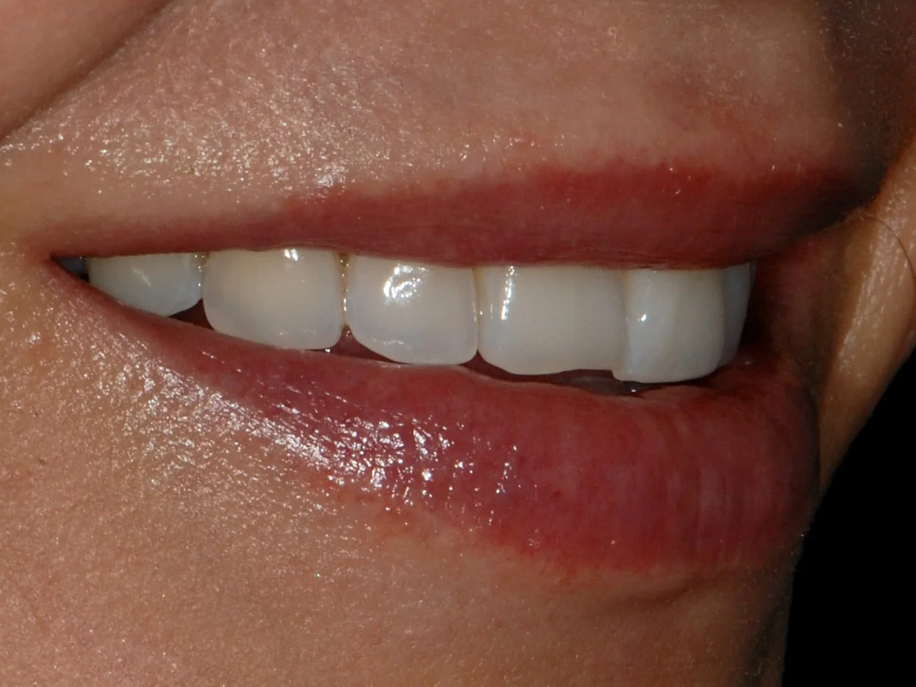 10 porcelain veneers, before treatment, left side view of smile
