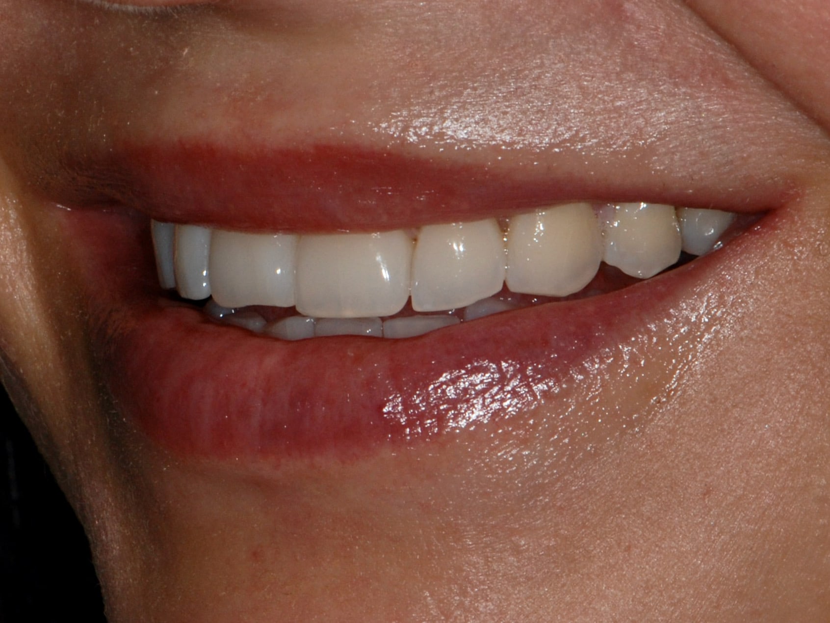 10 porcelain veneers, before treatment, right side view of smile