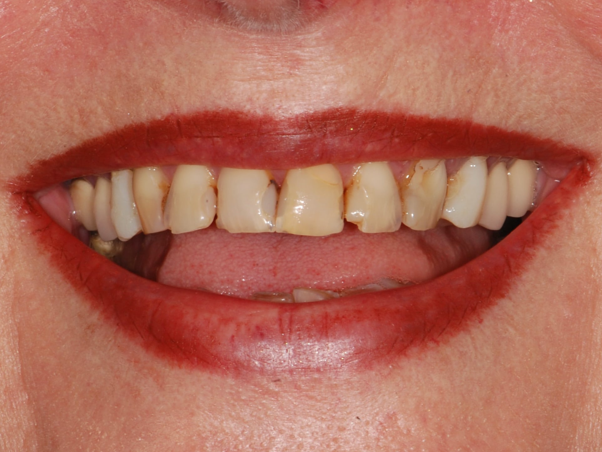 10 porcelain veneers, before treatment, front view of smile