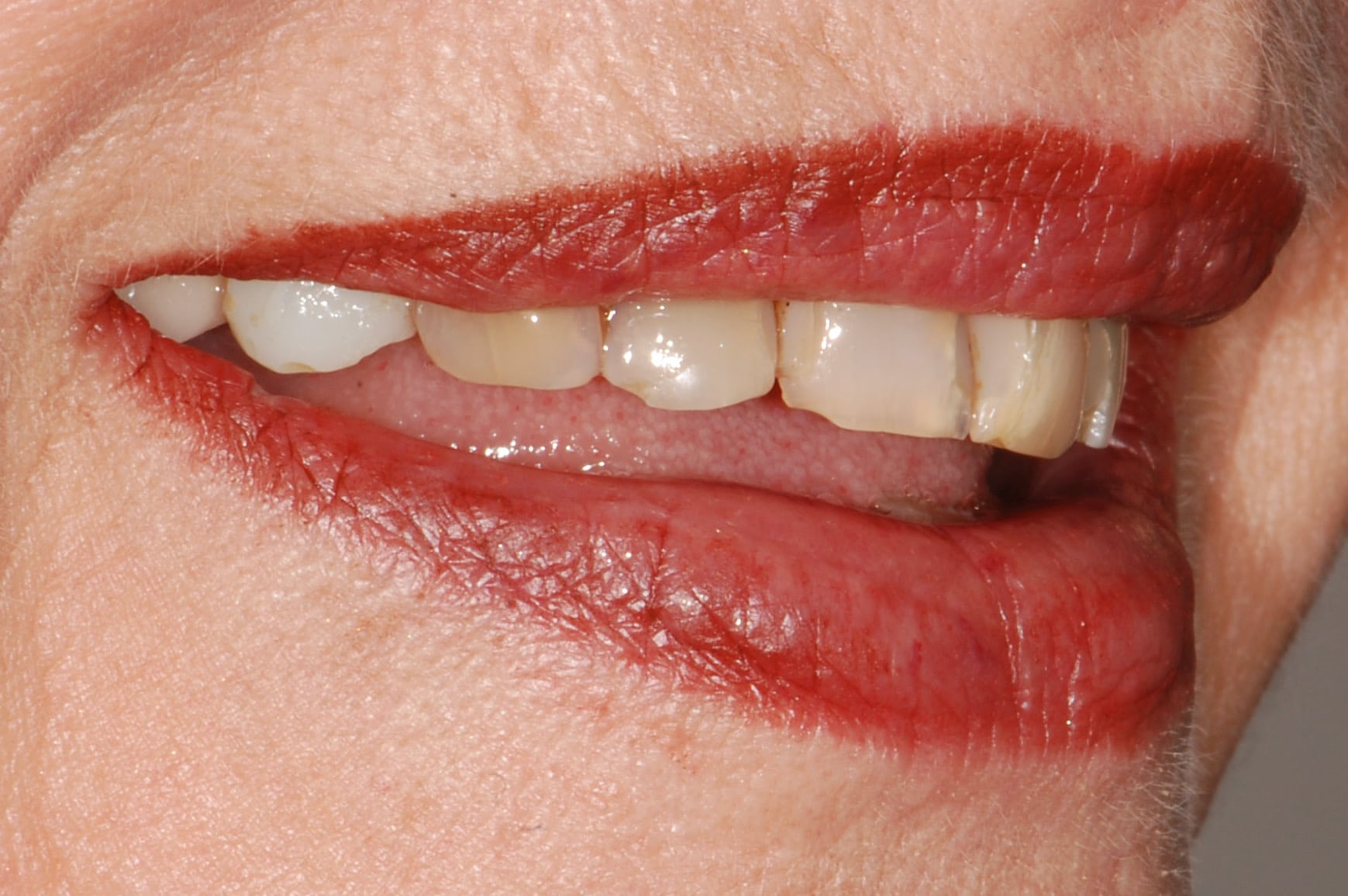 10 porcelain veneers, before treatment, left side view of smile
