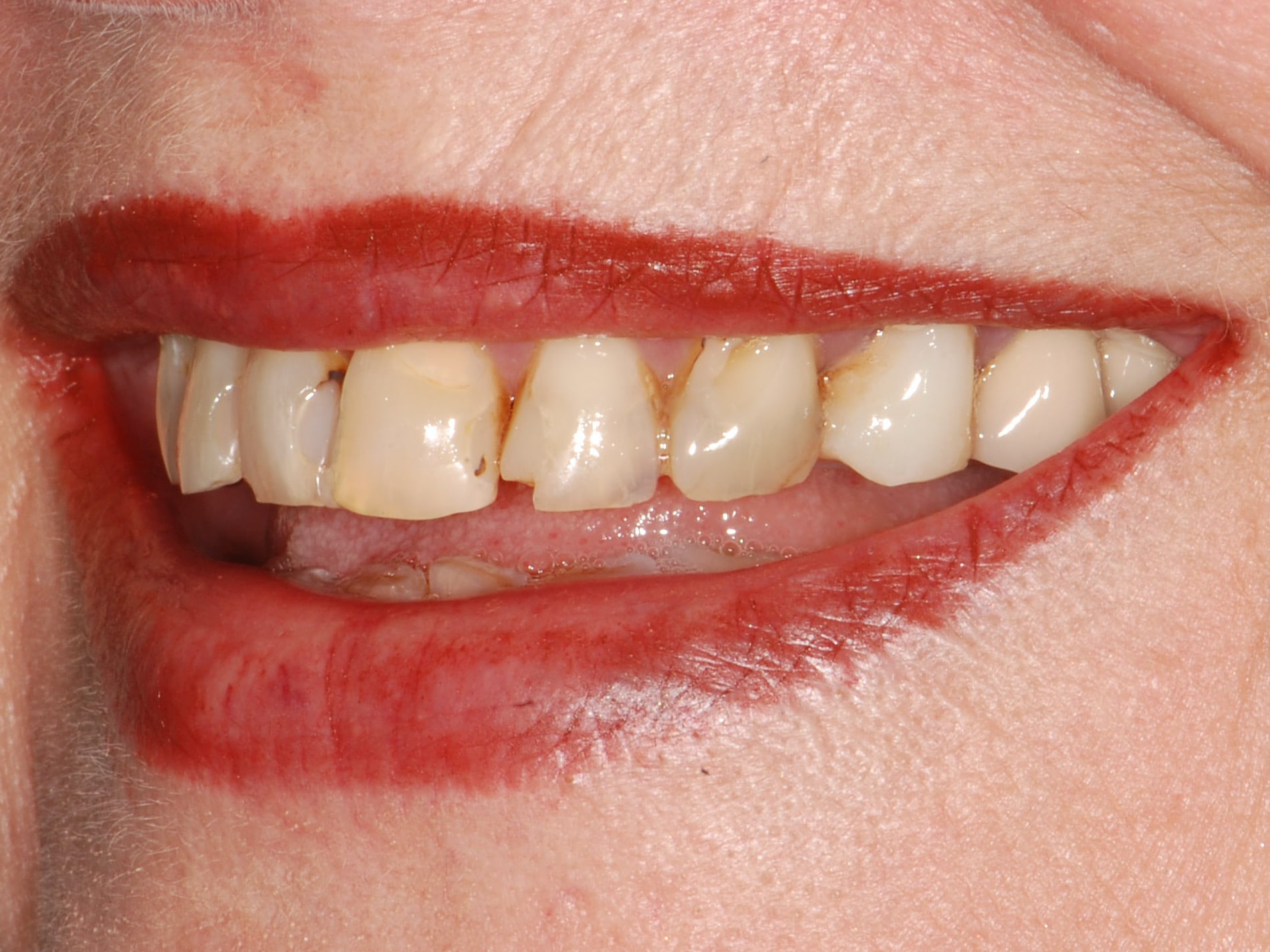 10 porcelain veneers, before treatment, right side view of smile