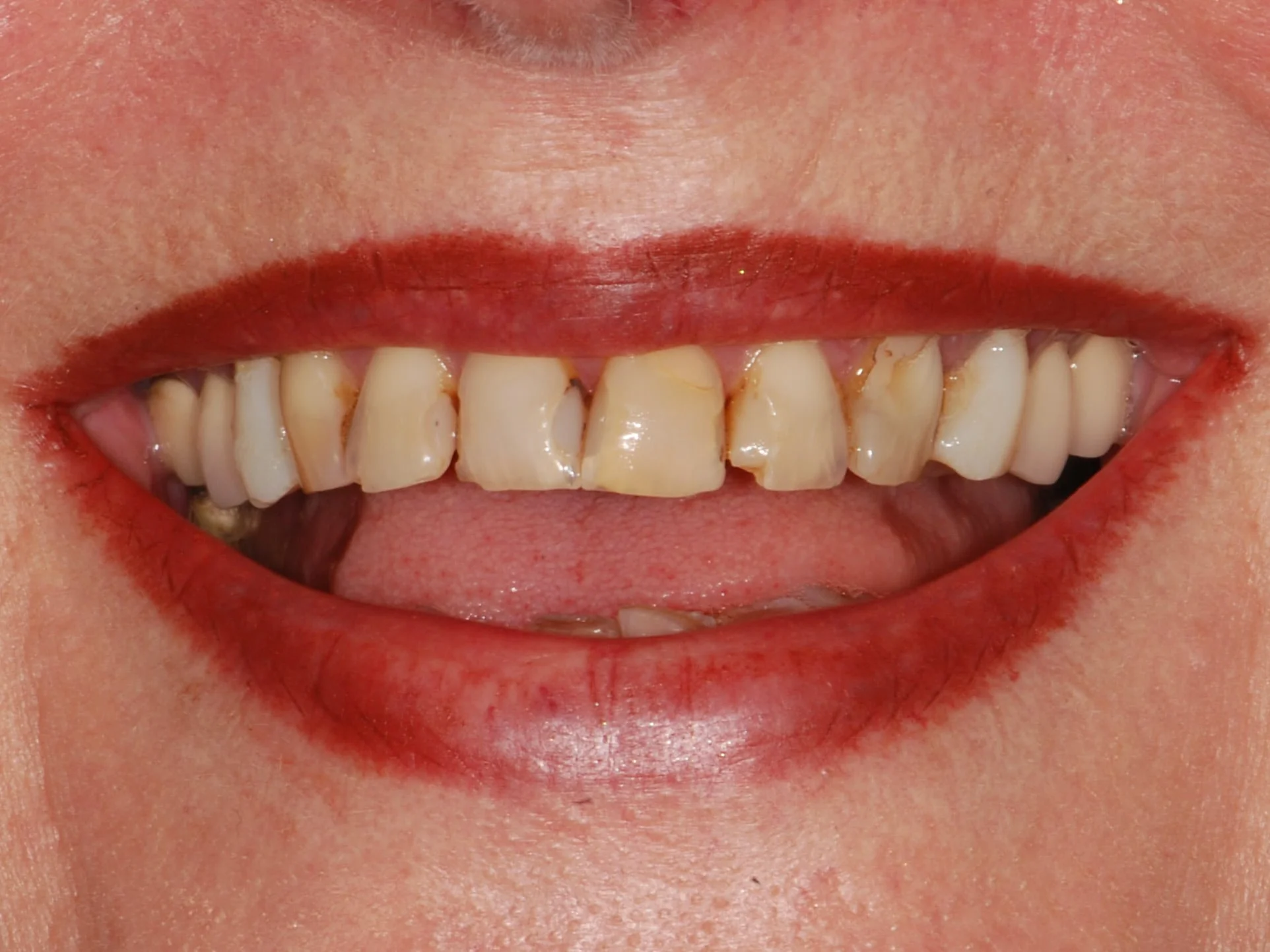 10 porcelain veneers, before treatment, front view of smile