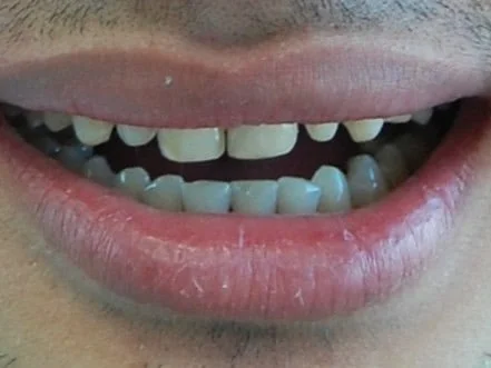 8 porcelain veneers, before treatment, front view of smile with lips