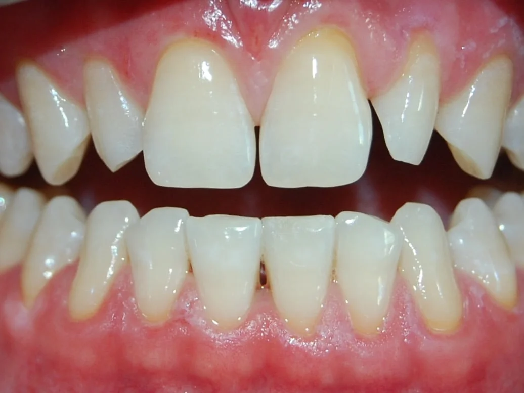 8 porcelain veneers, before treatment, front view of smile