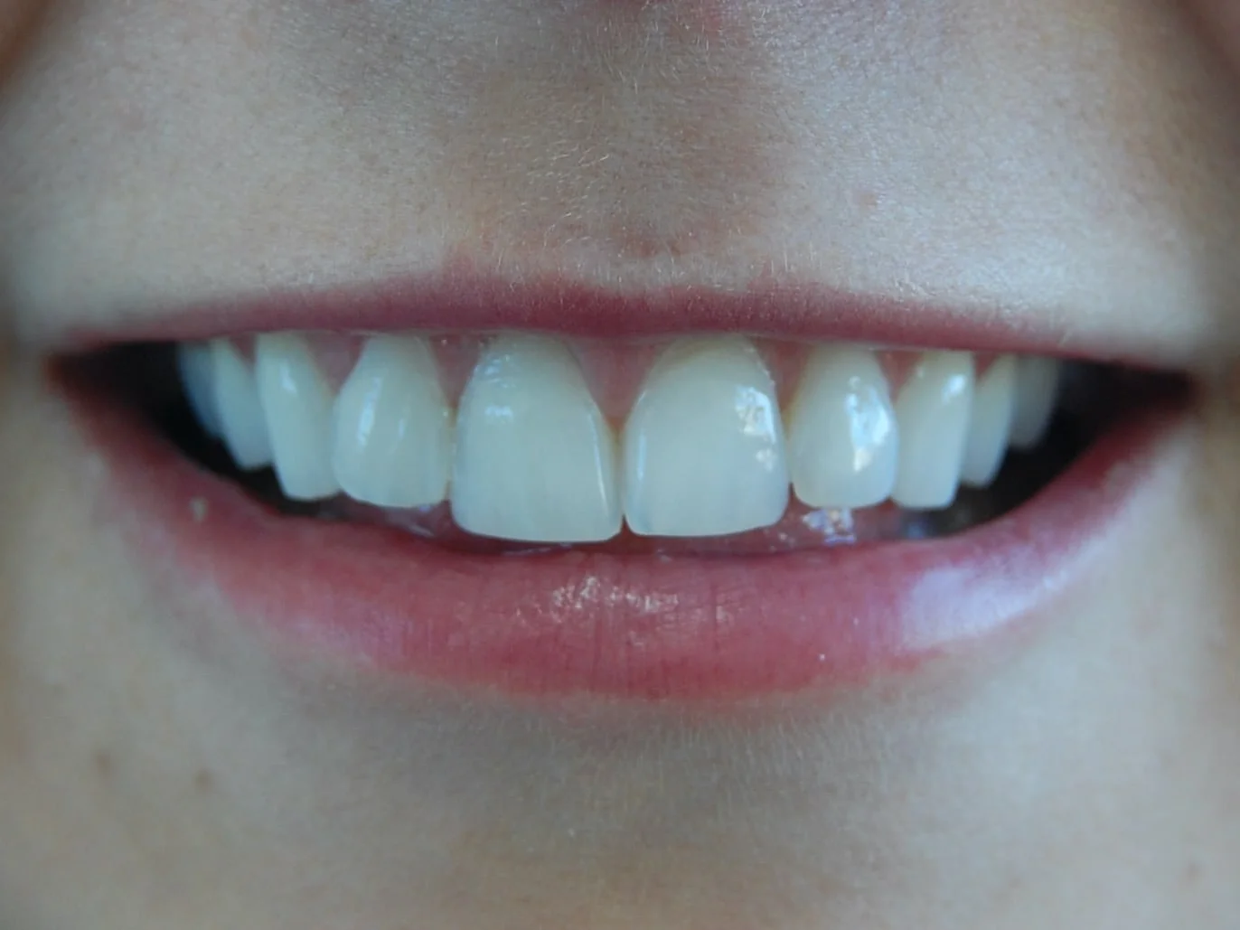 Porcelain veneers, before treatment, front view of smile