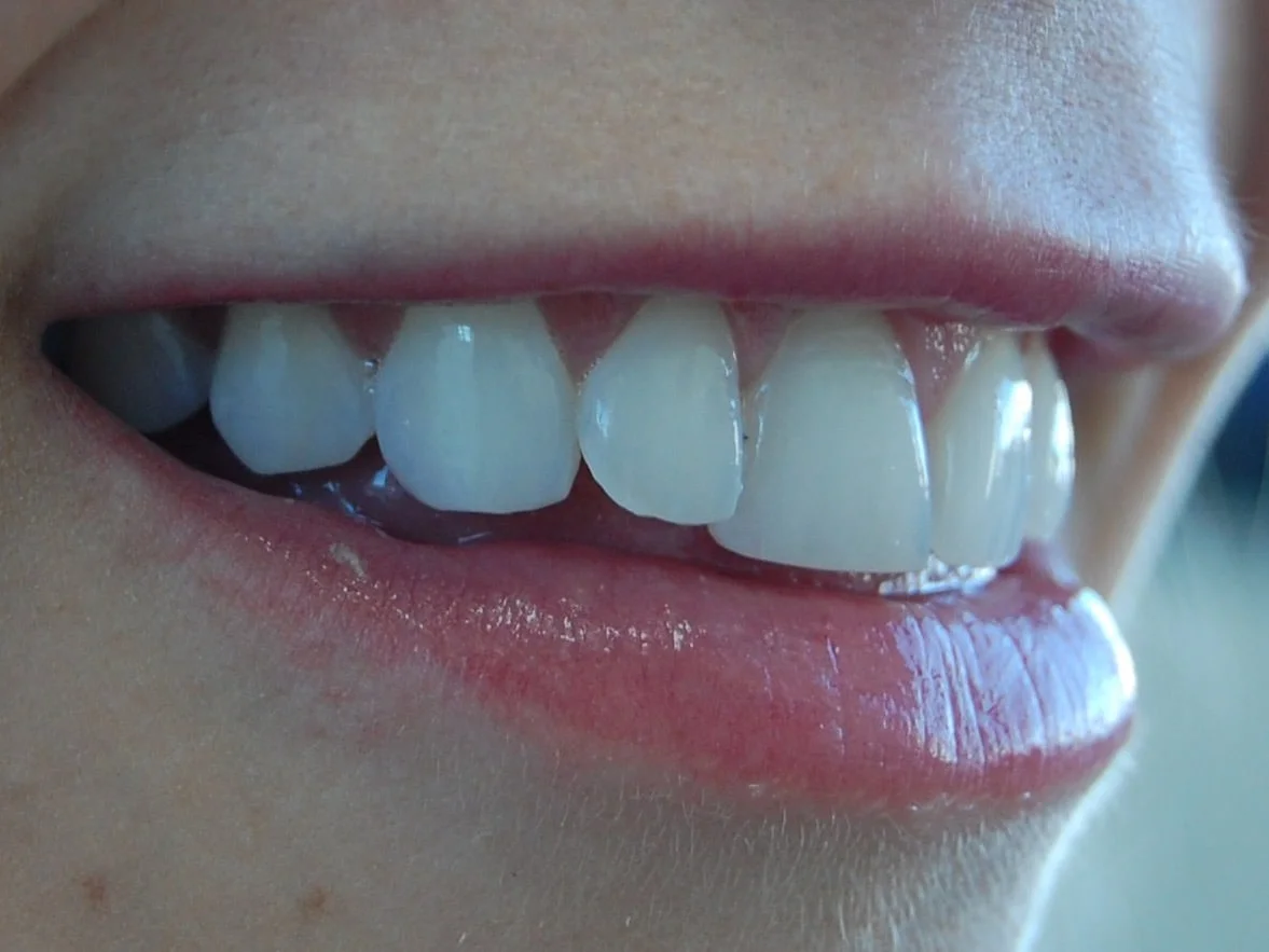 Porcelain veneers, before treatment, left side view of smile