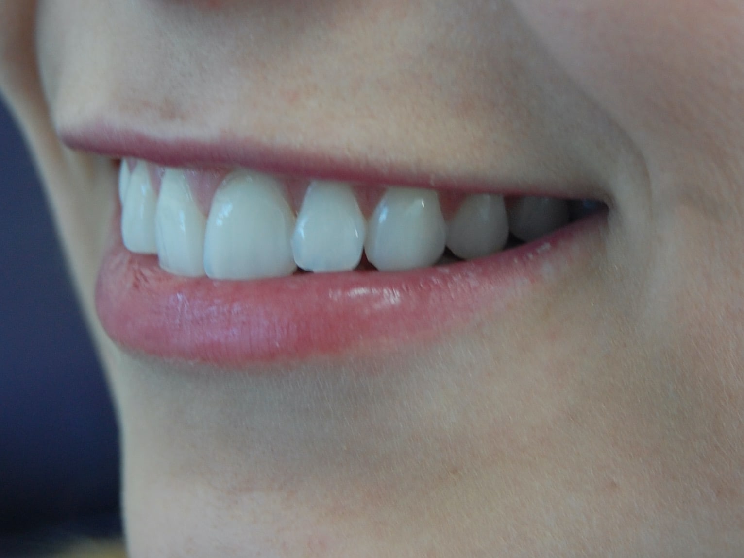 Porcelain veneers, before treatment, right side view of smile
